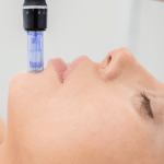 Mesoterapia / Mircroneedlig